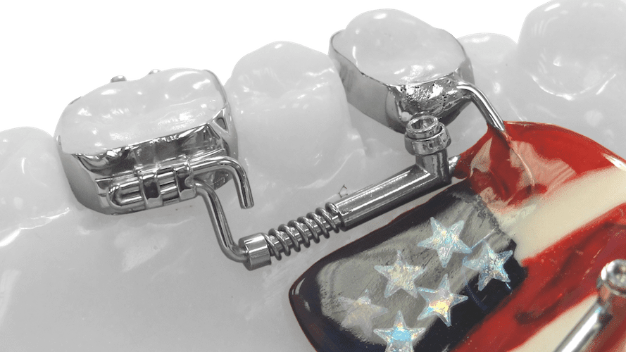 Distalizers | Ricoh Orthodontic Appliances